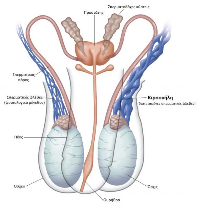 Varicocele spermatic cord veins infertility 768x792 1 696x718