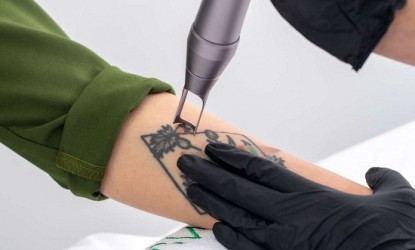 Όλα όσα πρέπει να γνωρίζεις προτού αφαιρέσεις ένα τατουάζ